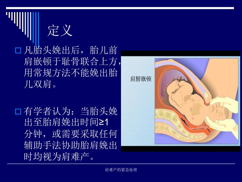 肩难产的紧急处理课件_第3页