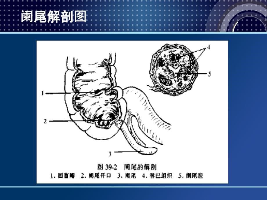 阑尾炎诊断治疗手术_第5页