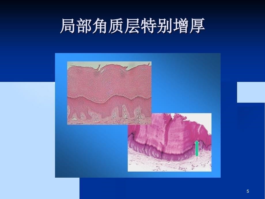 皮肤组织病理的基本变化共153页_第5页