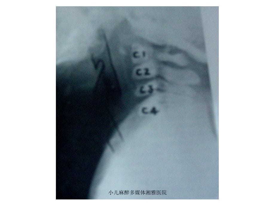 小儿麻醉多媒体湘雅医院课件_第5页