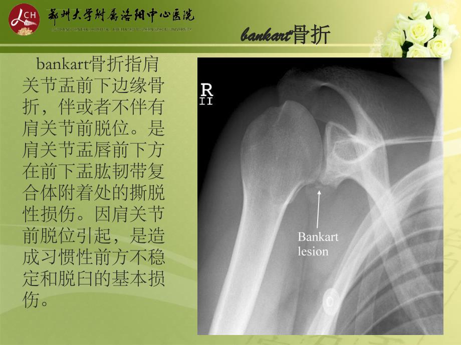 特殊类型骨折ppt课件_第2页