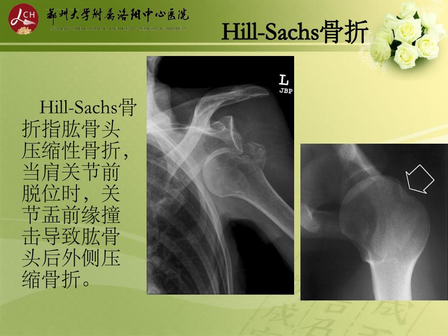 特殊类型骨折ppt课件_第3页