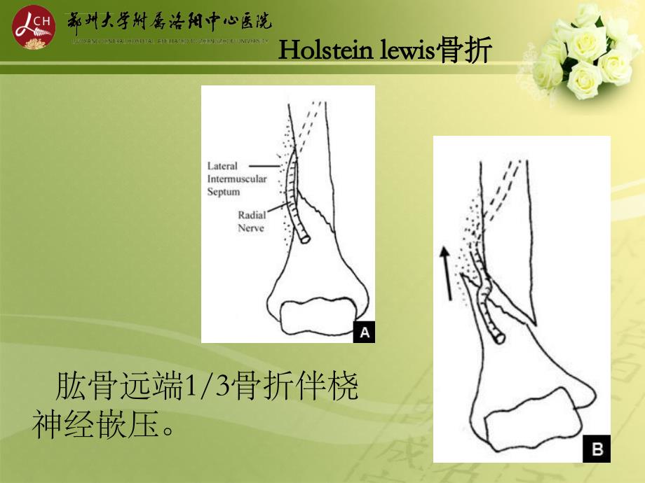 特殊类型骨折ppt课件_第4页