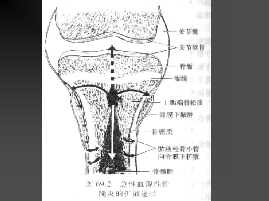 骨与关节化脓性感染化脓性骨髓炎pyogenicosteomyelitis概_第5页