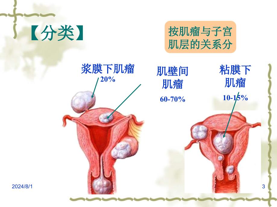 子宫肌瘤护理_第3页