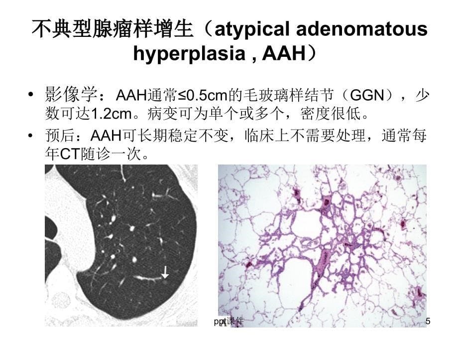 肺腺癌新分类ppt课件_第5页