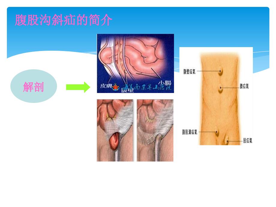 一例腹股沟斜疝病人护理查房_第4页