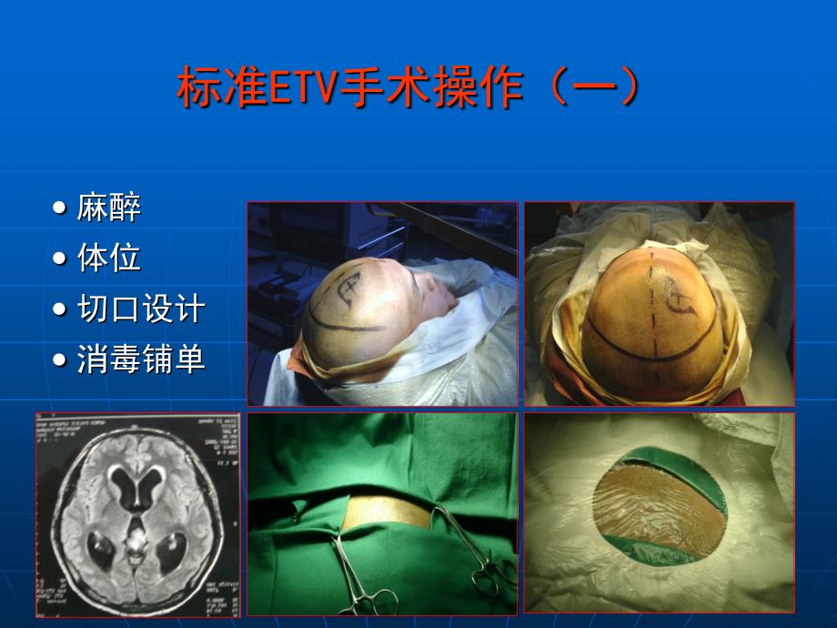 内镜第三脑室造口术(ETV)治疗脑积水_第3页