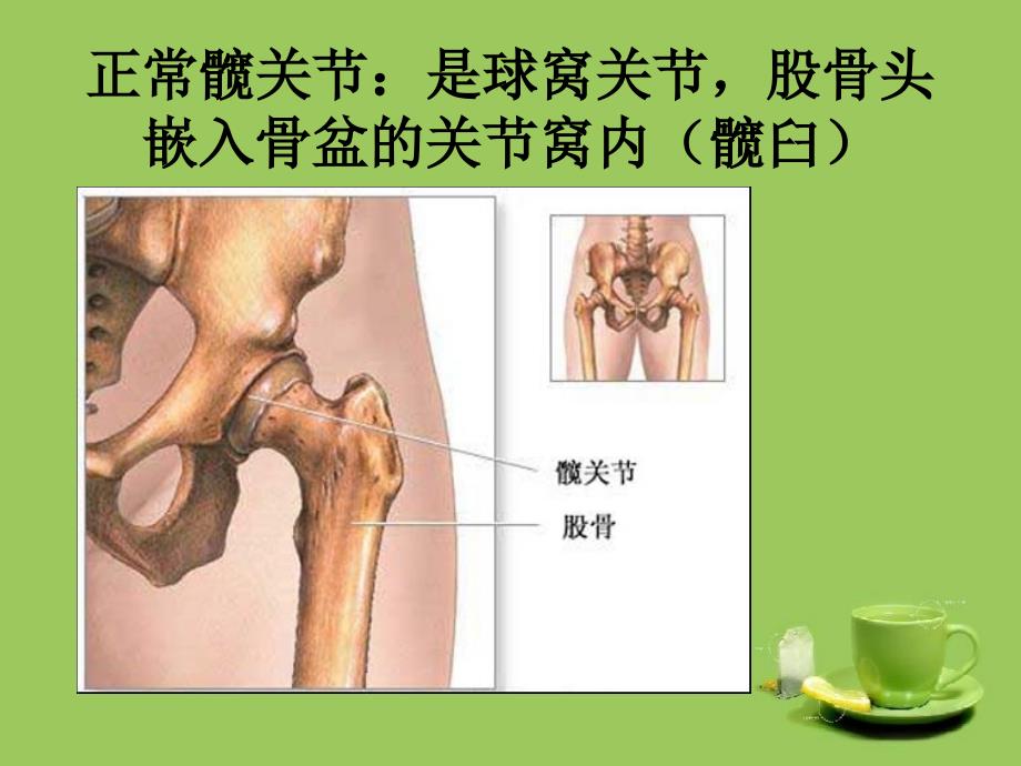 全髋关节置换护理查房_第4页