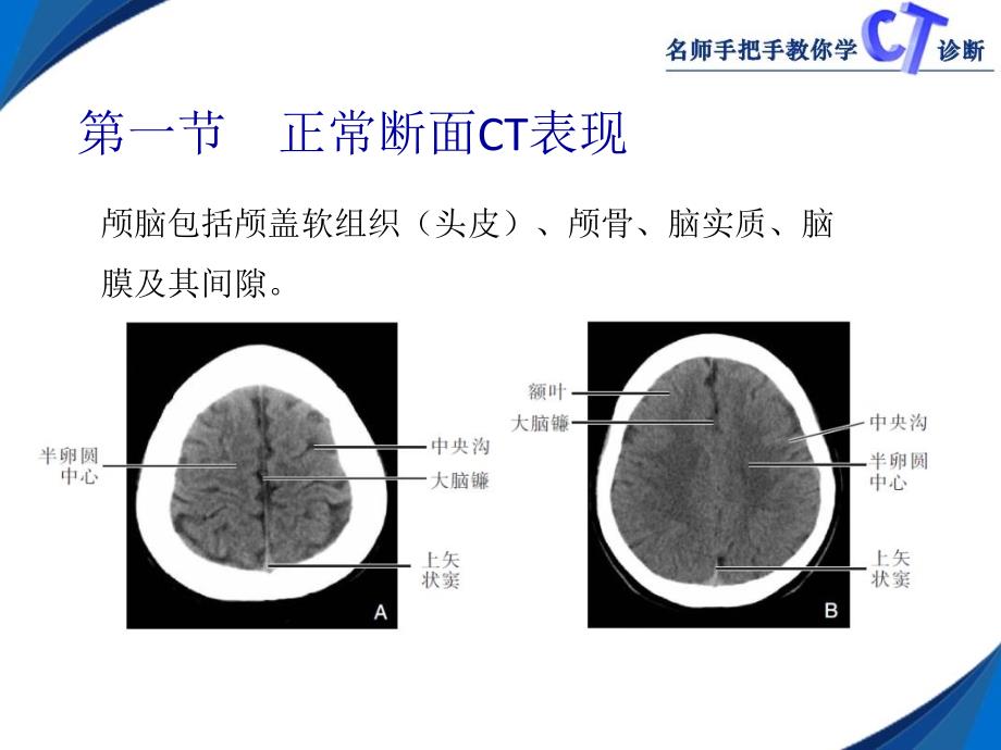 颅脑CT影像学表现_第2页