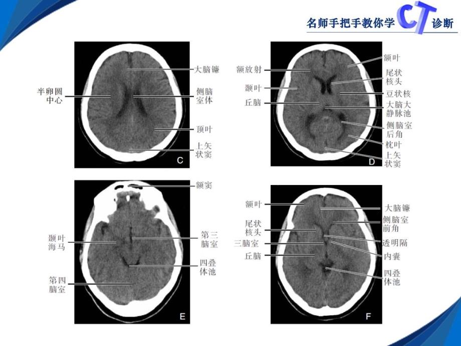 颅脑CT影像学表现_第3页