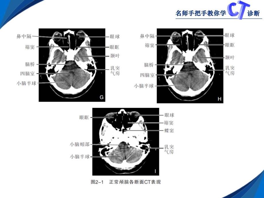 颅脑CT影像学表现_第4页