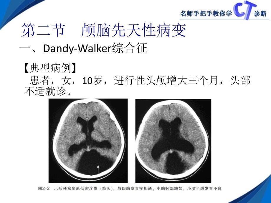 颅脑CT影像学表现_第5页