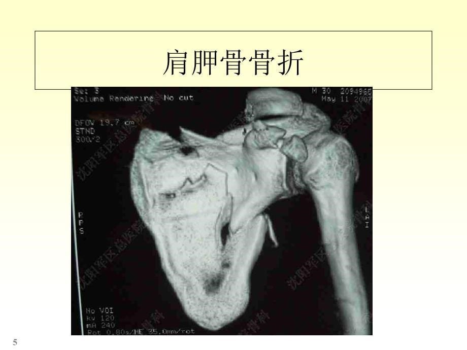 四肢骨骼解剖和骨折课件_第5页