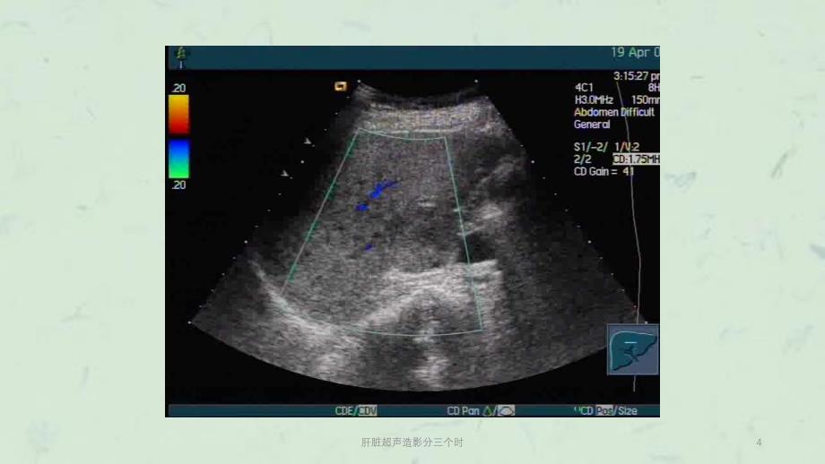 肝脏超声造影分三个时课件_第4页