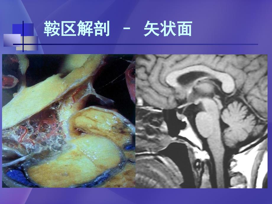 儿童鞍区常见肿瘤的影像学诊断高培毅ppt课件_第4页