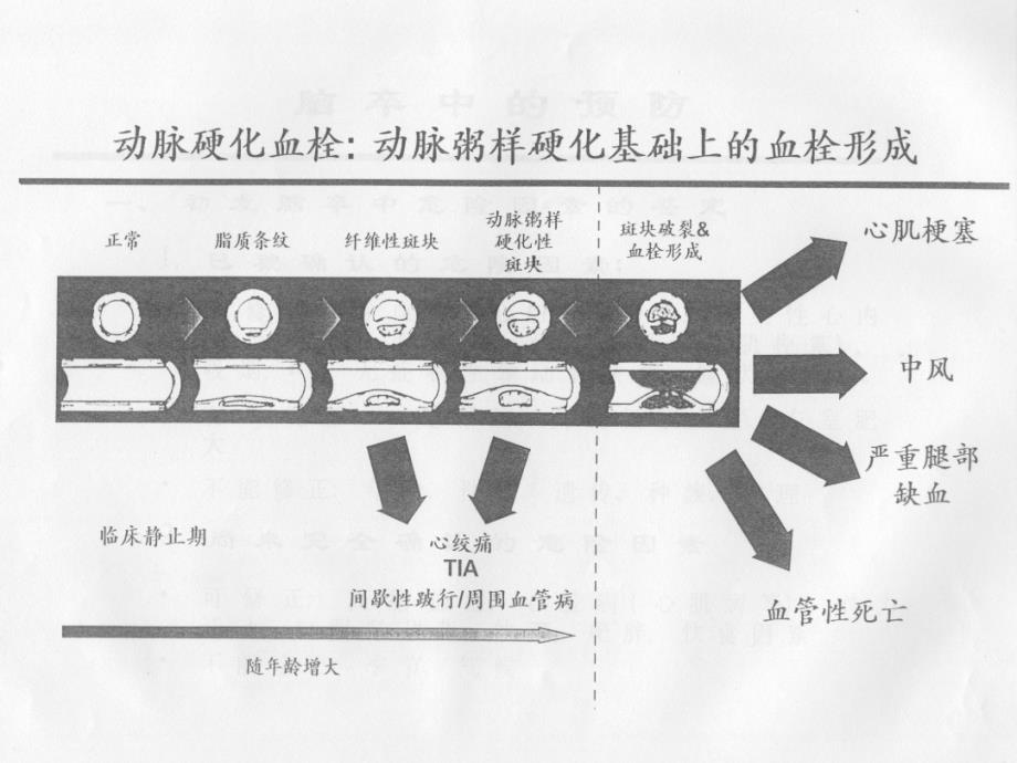 颅内血管狭窄的介入治疗ppt课件_第4页