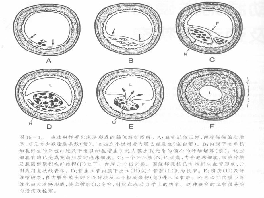 颅内血管狭窄的介入治疗ppt课件_第5页