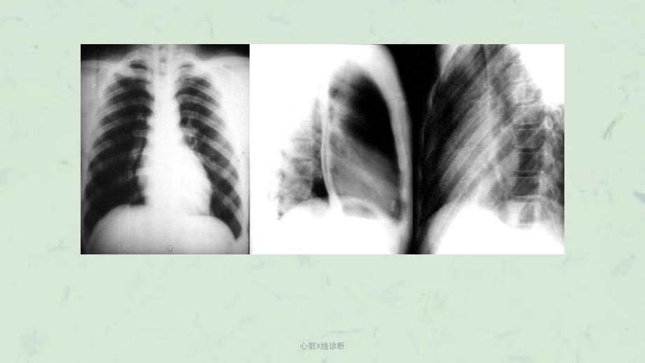 心脏X线诊断课件_第3页