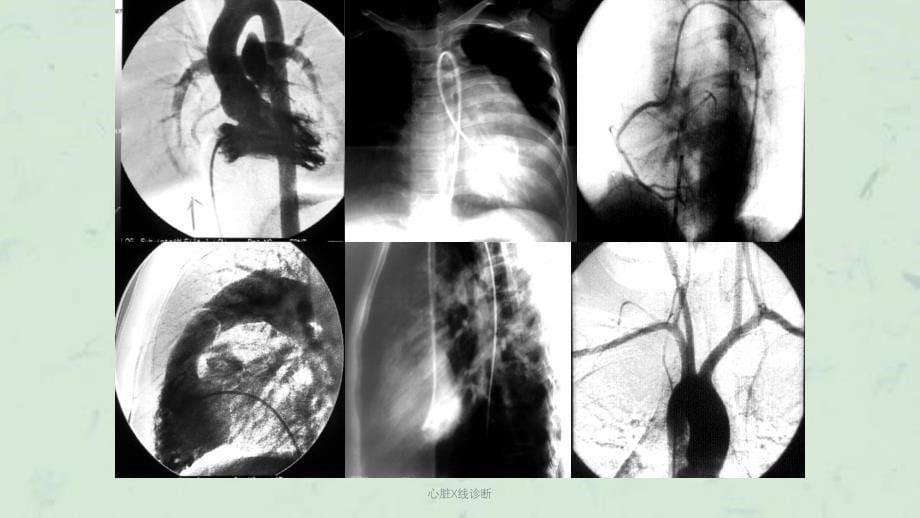 心脏X线诊断课件_第5页