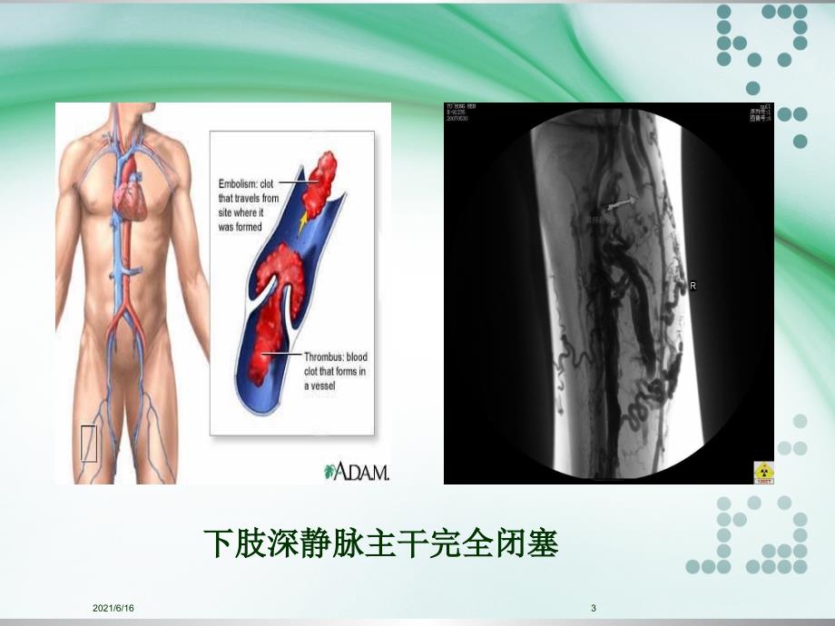 下肢深静脉血栓的护理.ppt_第3页