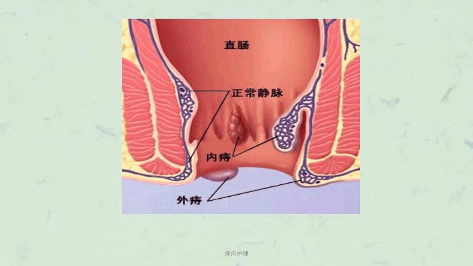 痔疮护理课件_第4页