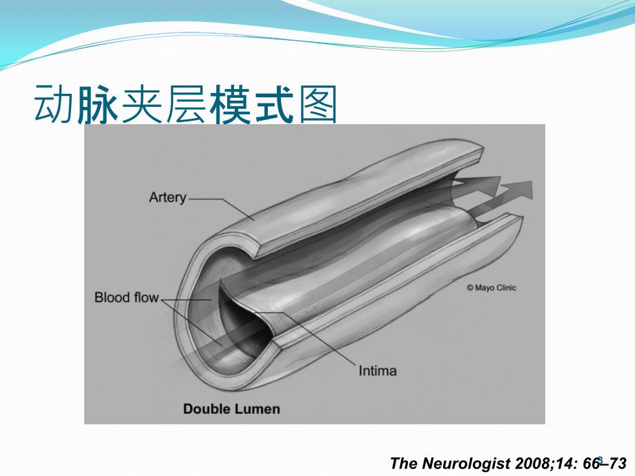 颈动脉夹层PPT参考幻灯片_第3页