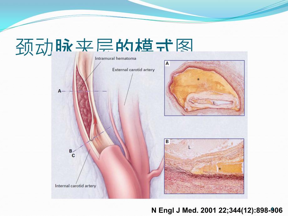 颈动脉夹层PPT参考幻灯片_第4页