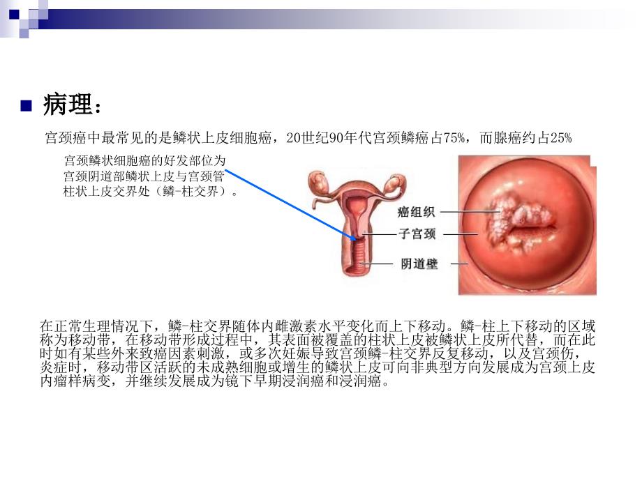 宫颈癌防治PPT_第4页