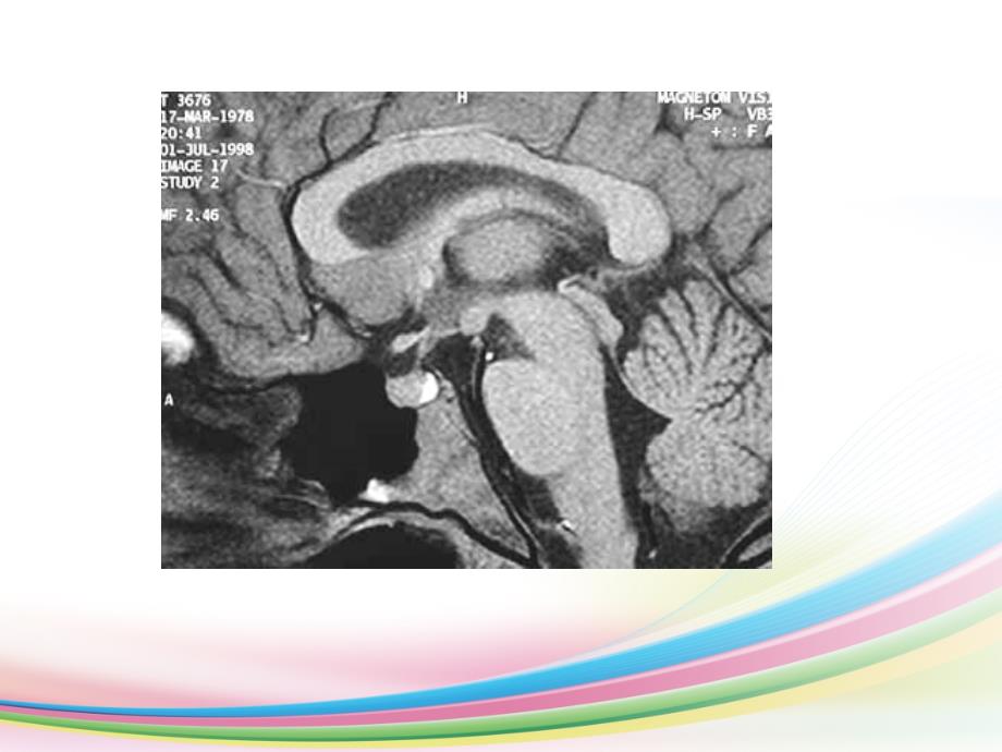 鞍区病变鉴别_第4页