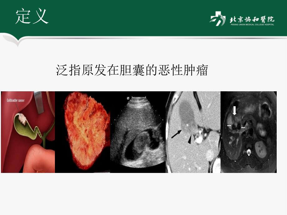 胆囊癌临床病理分期及外科决策协和医院刘乔飞课件_第2页