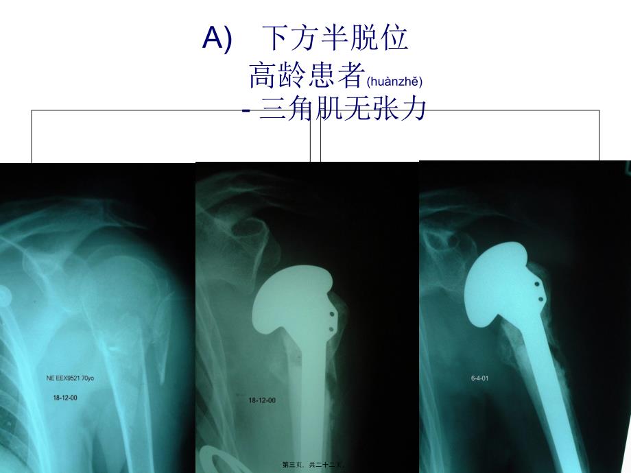 医学专题—肱骨近端骨折的并发症和后遗症---2_第3页