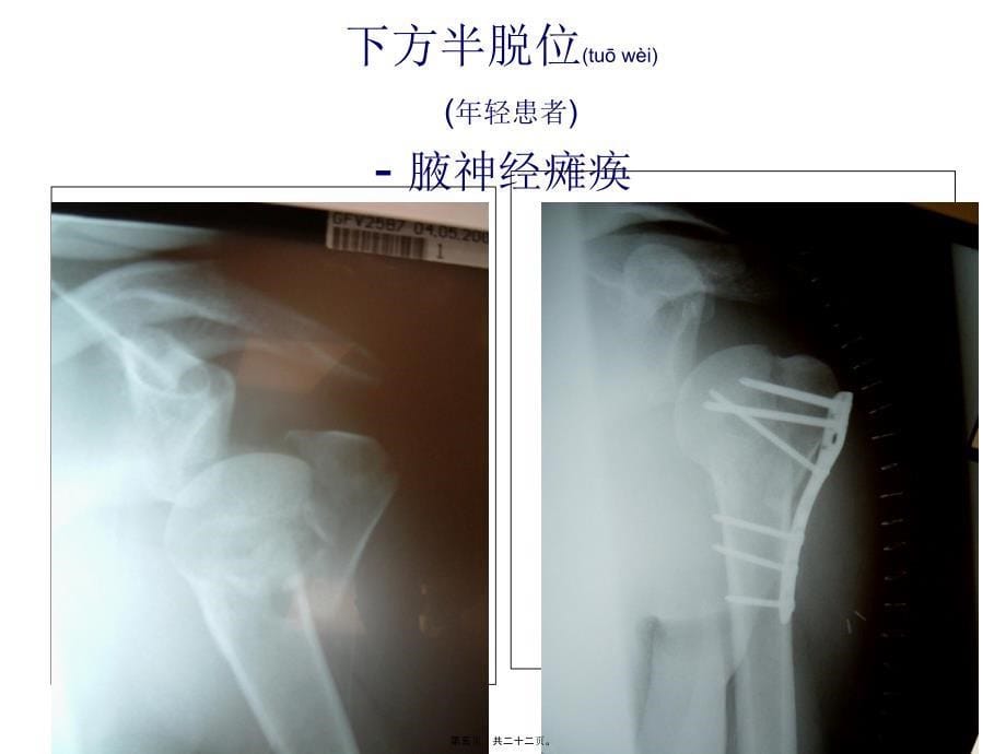 医学专题—肱骨近端骨折的并发症和后遗症---2_第5页