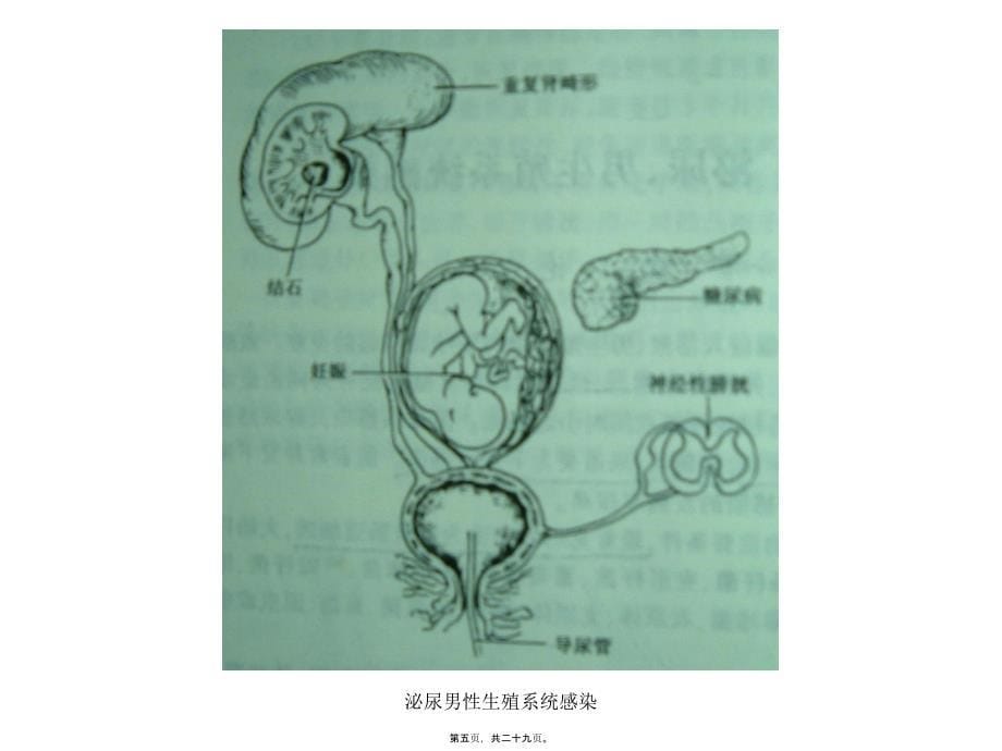 泌尿男性系统感染课件_第5页