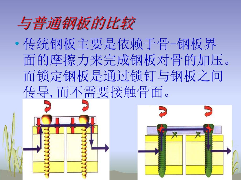 锁定钢板的应用PPT课件_第3页