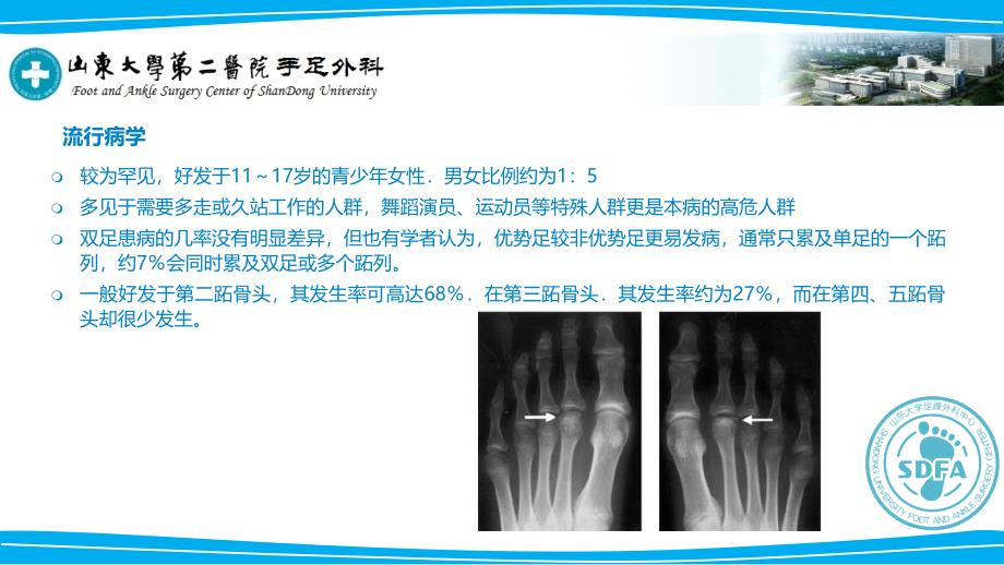 跖骨头缺血性坏死_第4页