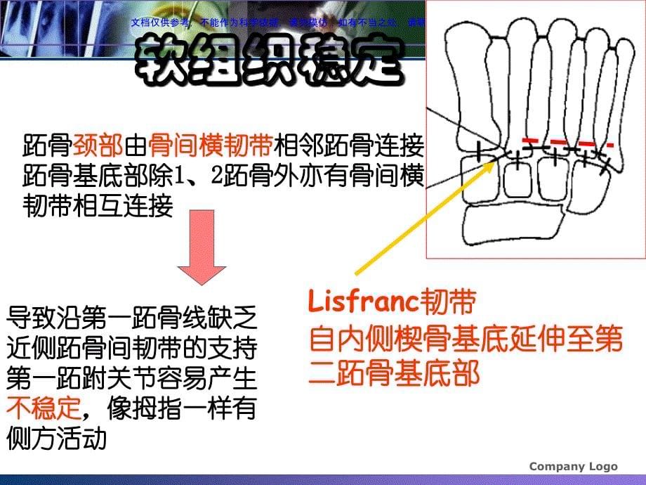 浅析Lisfranc损伤课件_第5页