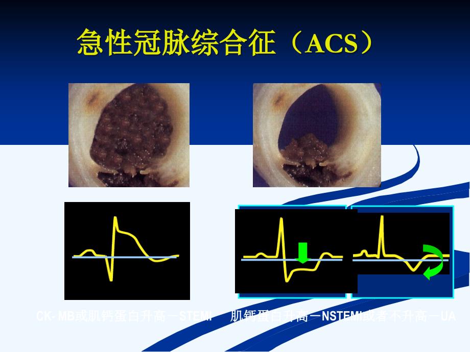 急性冠脉综合症-tr_第3页