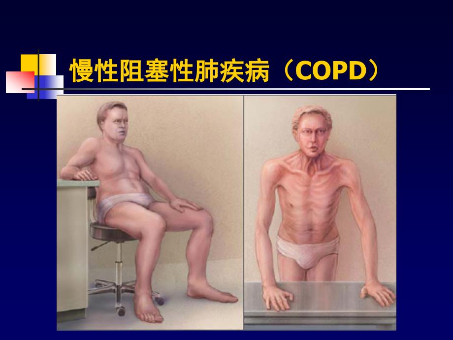 COPD一种伴有异常炎症反应的多因素构成的疾病_第2页