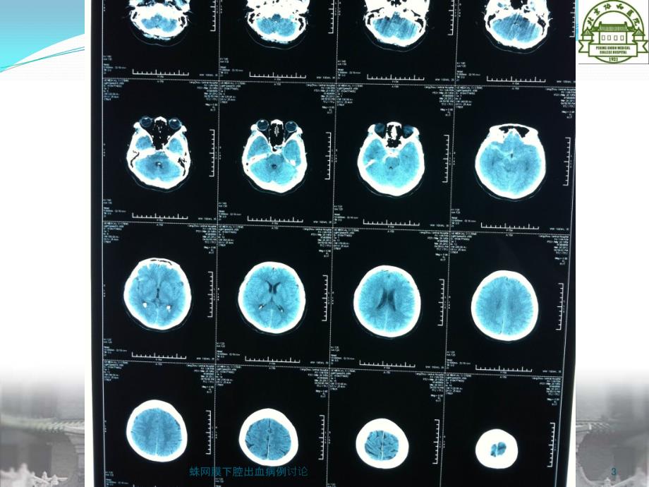 蛛网膜下腔出血病例讨论课件_第3页