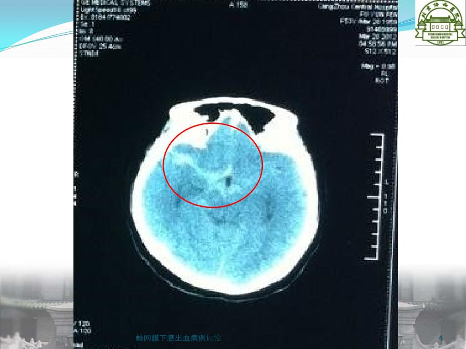 蛛网膜下腔出血病例讨论课件_第4页