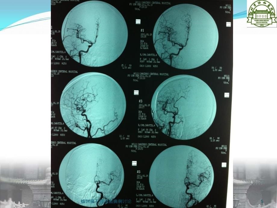 蛛网膜下腔出血病例讨论课件_第5页