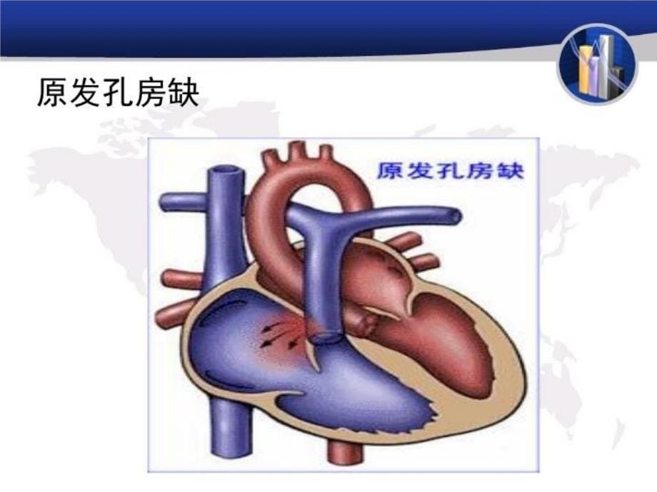 最新常见的心脏外科疾病简述PPT课件_第5页