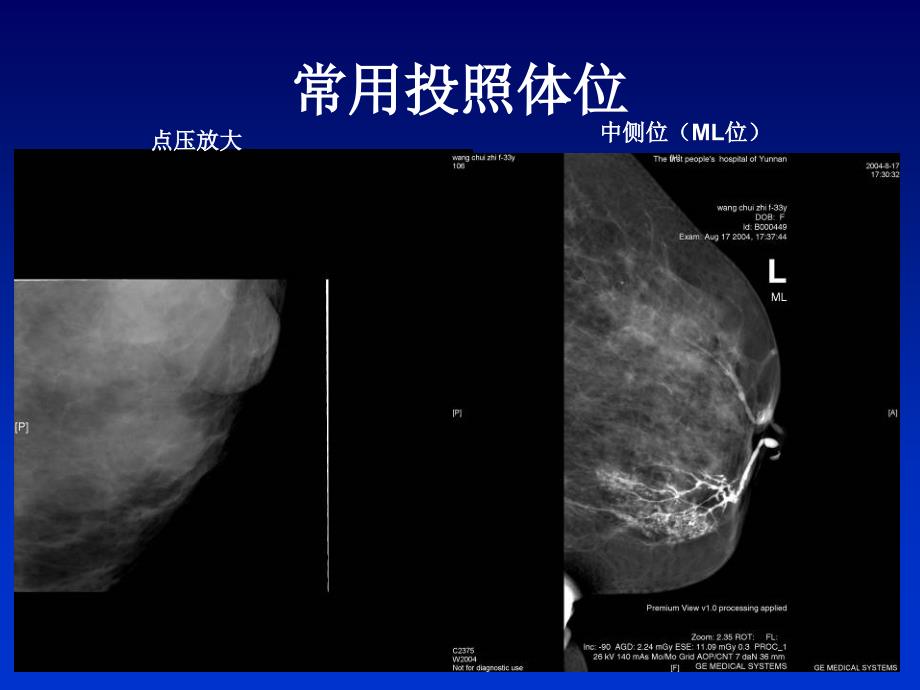 全数字化乳腺机的临床应用PPT文档_第3页