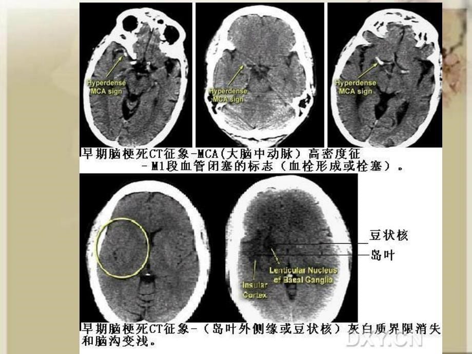 医学专题：急性脑卒中_第5页