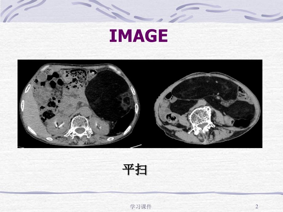 脂肪肉瘤一例CT表现业内参考_第2页