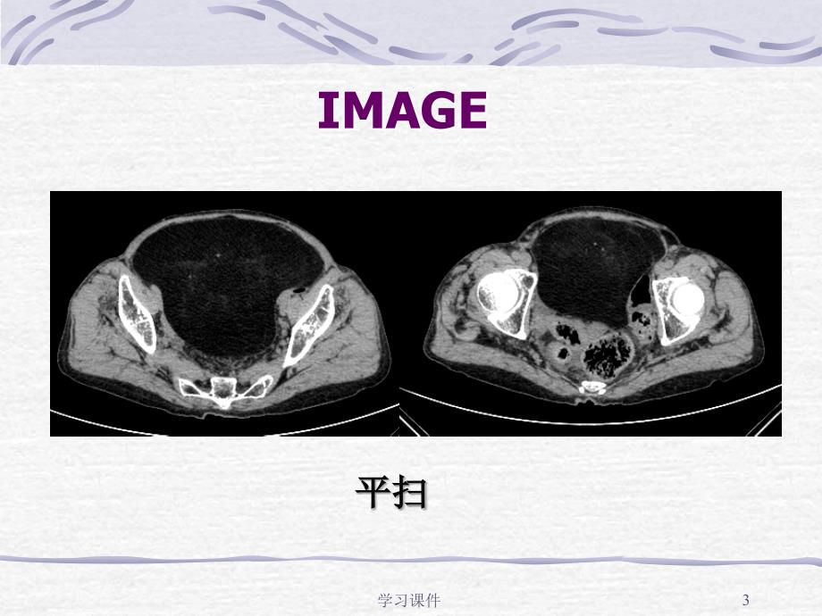 脂肪肉瘤一例CT表现业内参考_第3页