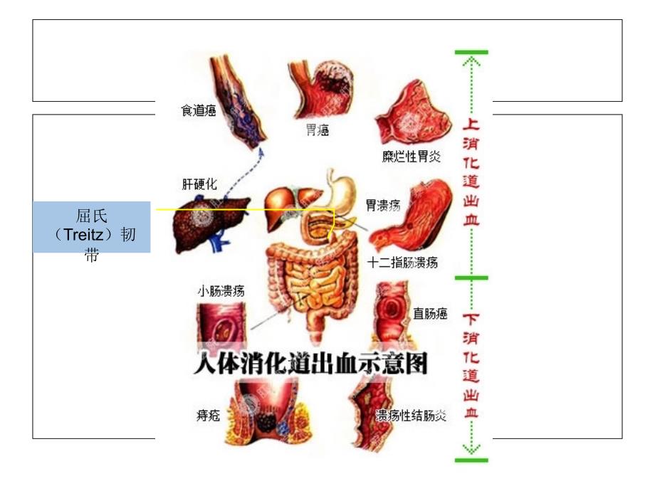 上下消化道出血鉴别_第2页