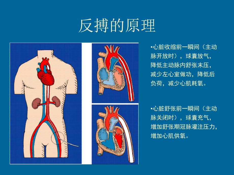 iabpautocat概述经整理ppt课件_第3页