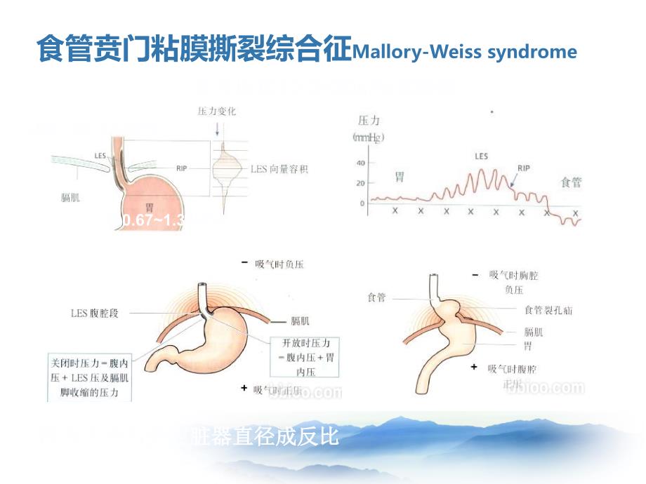 上消化道出血少见病因lcc_第3页